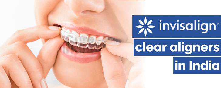 Invisalign - Clear Aligners